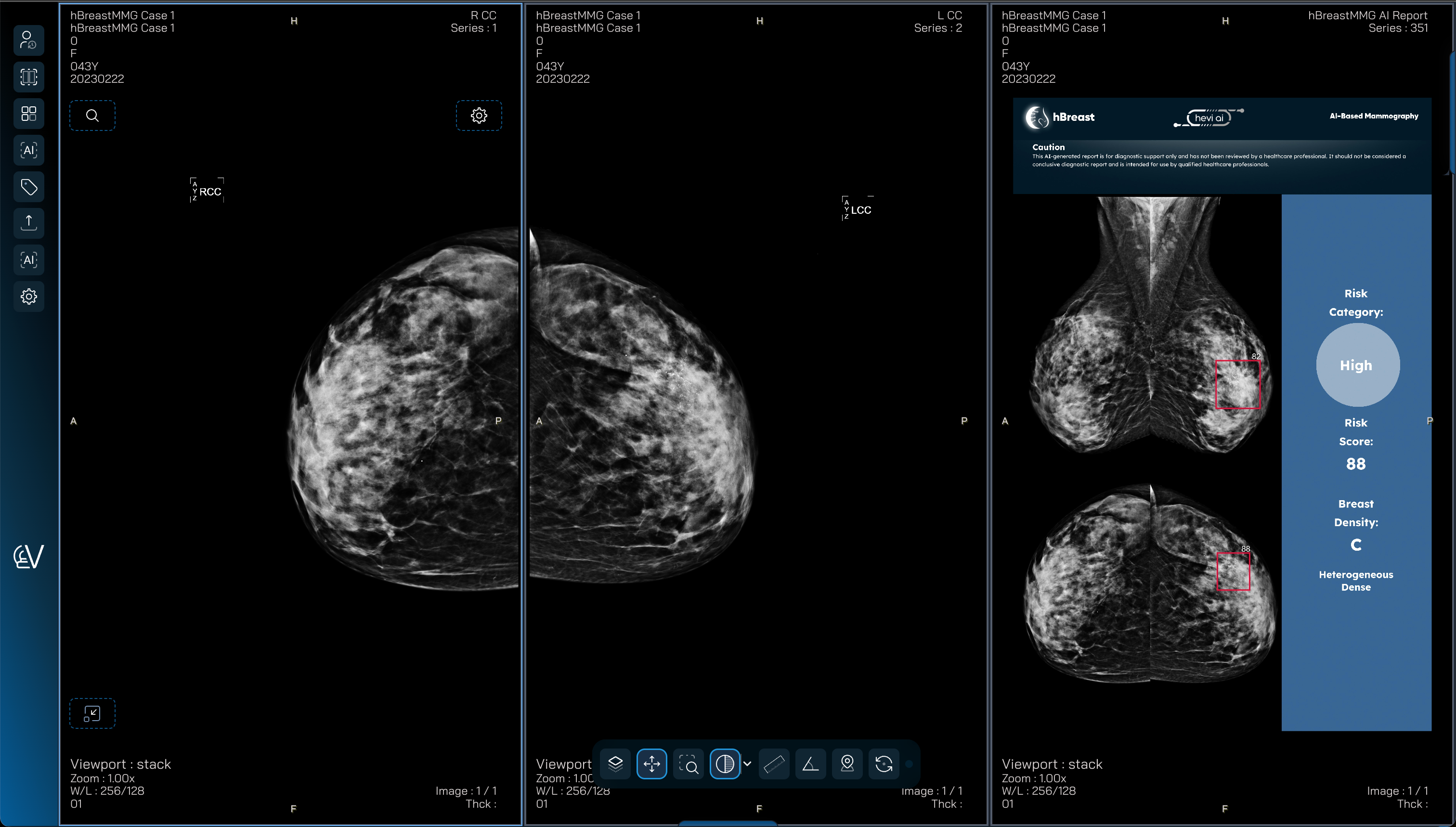 Hevi AI - hBreastMMG