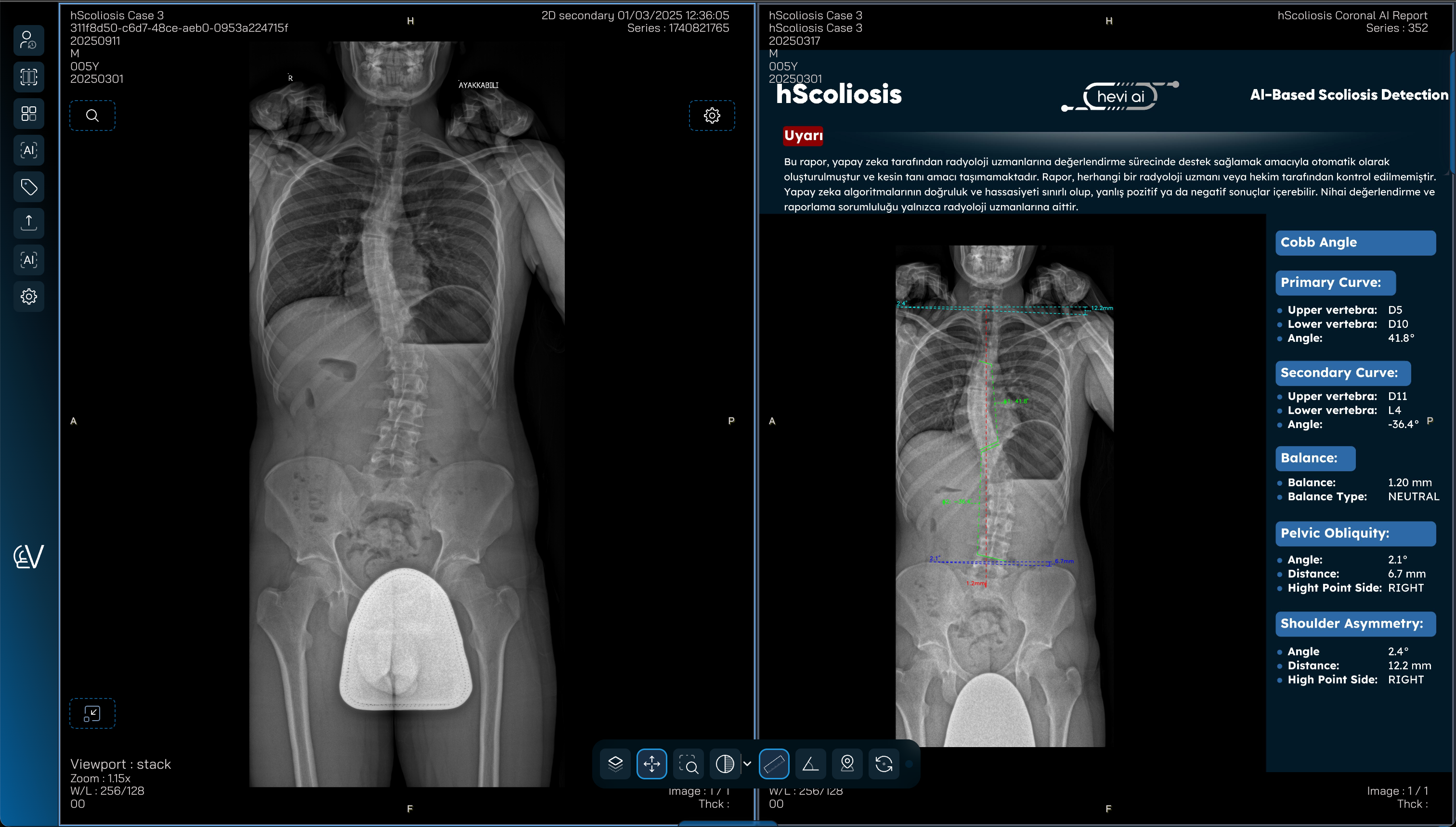 Hevi AI - hScoliosis